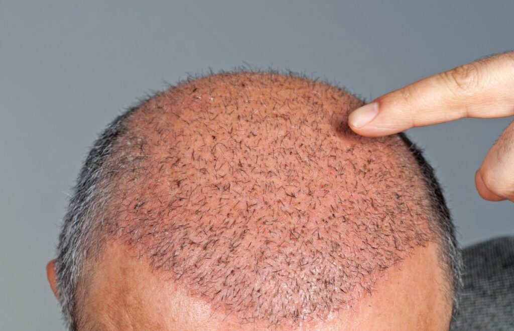 implant cheveux turquie