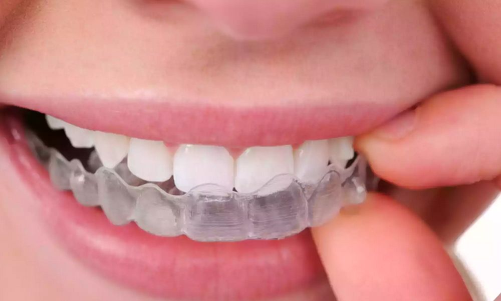 Invisalign